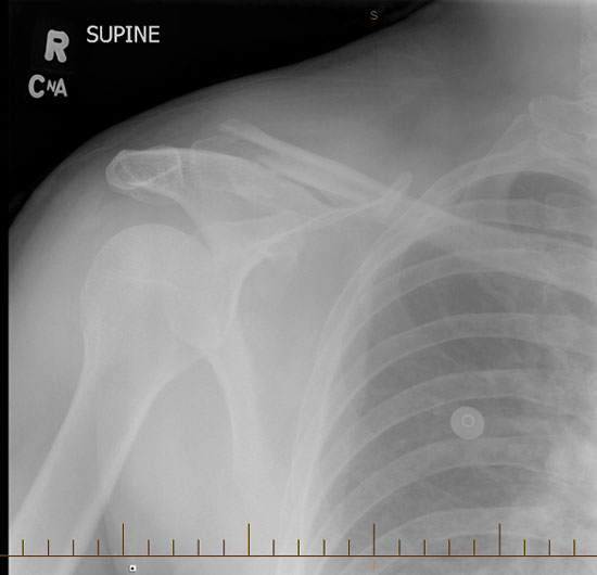 X-ray before the operation.