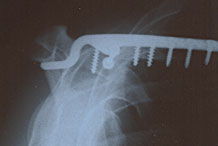 Click on the image to see the details oif this cool x-ray from Downhill Dave's shoulder :)