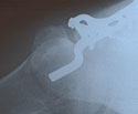 Click on the image to see the details oif this cool x-ray from Downhill Dave's shoulder :)