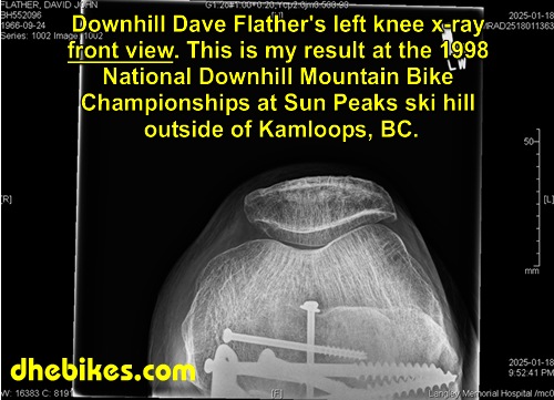 Click here for a larger x-ray of Downhill Dave Flather's left leg