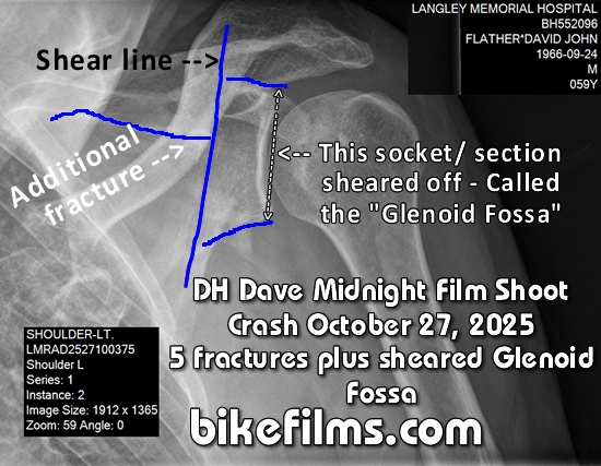 Click on the image for a larger pic of DH Dave's shatterred left scapula that happened on a midnight film shoot off a stump jump in Langley, BC