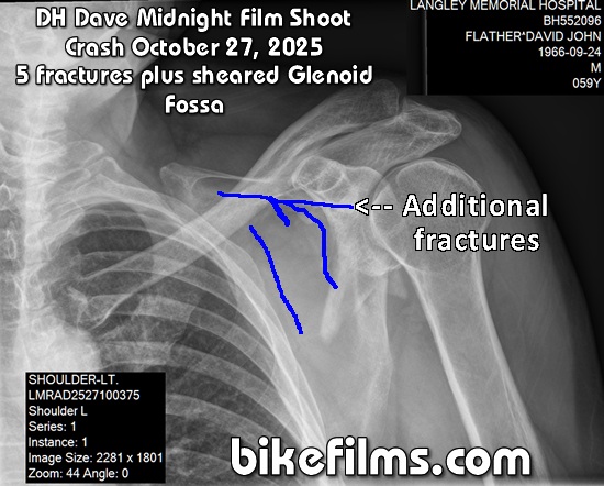 Click on the image for a larger pic of DH Dave's shatterred left scapula that happened on a midnight film shoot off a stump jump in Langley, BC